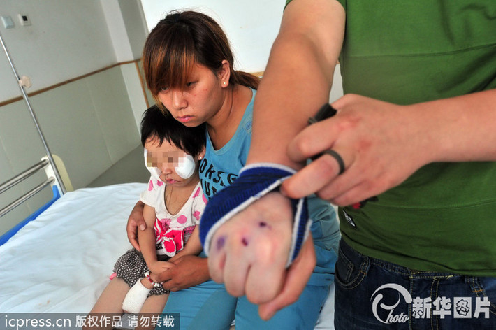 Những vết thương trên tay người cha khi cố gắng ngăn con chó hung bạo tấn công con gái.