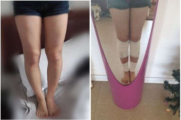 Hình ảnh đôi chân trước và sau khi phẫu thuật kéo dài chân.