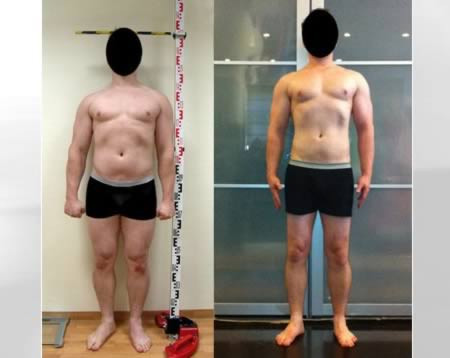 Không chỉ những cô gái mới tiến hành phẫu thuật kéo dài xương chân để có đôi chân dài như ý mà nhiều chàng trai cũng có thể thực hiện phương pháp này để cải thiện chiều cao.
