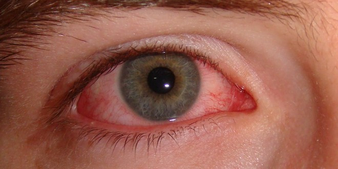 Đau mắt đỏ do virus đang ở thời điểm bắt đầu mùa dịch, dự báo bệnh sẽ còn diễn biến phức tạp trong thời gian tới. Tuy nhiên, các bác sĩ chuyên khoa mắt cũng khẳng định việc phòng bệnh đau mắt đỏ không hề khó khăn.