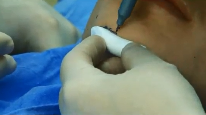 Phẫu thuật độn cằm đòi hỏi phải bóc tách lớp thịt ở trong cằm rồi dùng khoan để cố định lại các phần được lắp ráp.