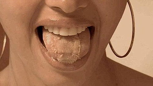 Phẫu thuật vá… lưỡi. Nếu chế độ ăn kiêng của bạn không thành công, có thể phẫu thuật vá lưỡi sẽ giúp bạn. Thủ tục phẫu thuật này là một cách khác để giảm cân và chỉ có thể được một nhóm các bác sĩ phẫu thuật ở Hoa Kỳ thực hiện. Đó là, với một ít thuốc gây tê đầu lưỡi để may một miếng nhựa mỏng có kích thước bằng một con tem lên đầu lưỡi.