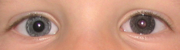 Bên cạnh đó, theo thời gian khối u có xu hướng thay đổi màu sắc. Thông thường, nó trở nên nhạt hơn so với màu tự nhiên của mắt. Những người sở hữu đôi mắt đen là khó phát hiện hơn cả nên càng phải đặc biệt chú ý. Một khi bệnh chuyển sang giai đoạn sau, màu sắc khó xác định sẽ lấn sang các vị trí khác ở mắt.