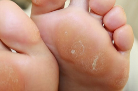Chữa chai chân: Lấy nhân hạt gấc, giữ cả màng hạt, giã nát, thêm một ít rượu trắng 35 – 40 độ, bọc trong một cái túi nilon. Dán kín miệng túi, khoét một lỗ nhỏ rộng gần bằng chỗ chai chân, buộc vào nơi tổn thương, 2 ngày thay thuốc một lần. Băng liên tục cho đến khi chỗ chai chân rụng ra (khoảng 5 – 7 ngày sẽ có kết quả). Ảnh: me.phununet.vn.