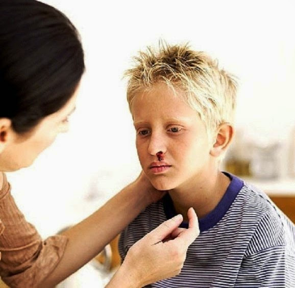 Khí hậu khô khắc nghiệt: Điều này thường gặp ở những bệnh nhân có độ lệch vách ngăn vì luồng không khí khi đi qua một diện tích hẹp trong mũi sẽ nhanh hơn và làm cho mũi khô hơn. Điều này gây ra sự kích thích, tiếp theo là hắt hơi và làm chảy máu mũi.