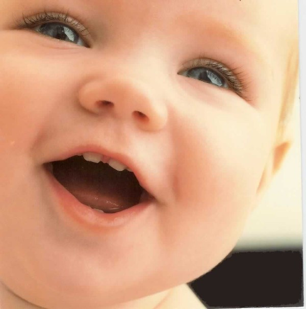 Thở miệng còn làm cho bệnh nhân dễ bị sâu răng hơn, có nhiều răng sâu hơn bình thường, vì thở miệng làm khô nước bọt, khô miệng sẽ làm hơi thở hôi, răng ở tình trạng không có nước bọt để rửa sạch sẽ dễ bị sâu và mức độ sâu phát triển nhanh và trầm trọng hơn.