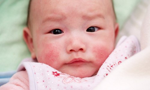 Các biểu hiện thường thấy của dị ứng sữa là có máu trong phân, con cũng bị tiêu chảy và nôn mửa. Nếu bé hay bị nổi mề đay, phát ban xung quanh miệng và cằm, ho, thở khò khè hoặc khó thở cũng có thể là dấu hiệu cho thấy hệ hô hấp của bé bị ảnh hưởng bởi dị ứng sữa. Nếu các triệu chứng này tăng dần hãy nói chuyện với bác sĩ.