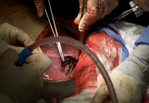 Giáo sư Karl Oldhafer cùng nhóm bác sĩ thực hiện ca phẫu thuật đang tiến hành khâu lại gan sau khi loại bỏ các khối u gây bệnh.