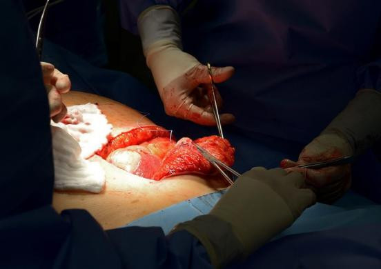 Các bác sĩ đang tiến hành phẫu thuật gan cho bệnh nhân, gan, một trong những ca phẫu thuật nội tạng đầu tiên ở Đức với sự hỗ trợ của một máy tính bảng để truy cập và hiển thị dữ liệu.
