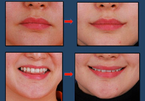 Sự khác biệt thấy rõ về ngoại hình khi các cô gái chỉnh sửa khuôn miệng theo hướng đi lên tươi tắn.