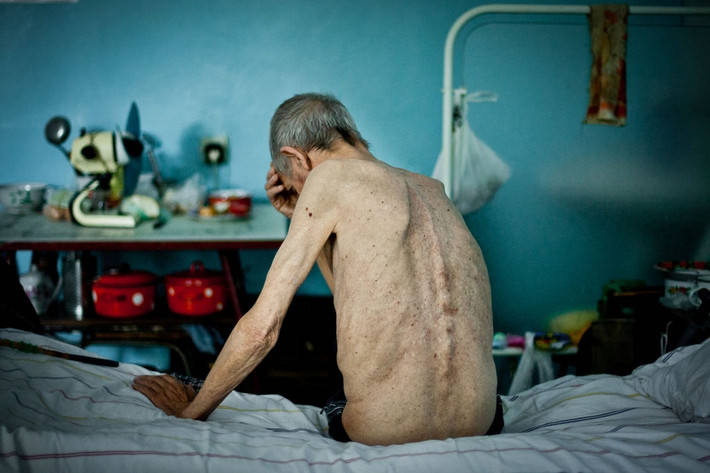 Michael, 63 tuổi, ngồi trên giường trong bệnh viện lao Kherson. Ông đã được điều trị căn bệnh này từ năm 1983.