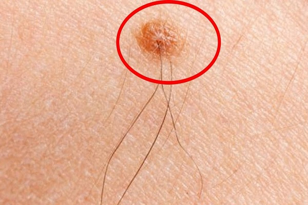Lông mọc trên nốt ruồi. Không kể là nam hay nữ, nếu trên nốt ruồi có lông mọc thì đều là điềm lành, báo tài lộc. Tuy nhiên, người xưa có câu: ''Một lông cô quạnh, ba lông chủ phát tài".