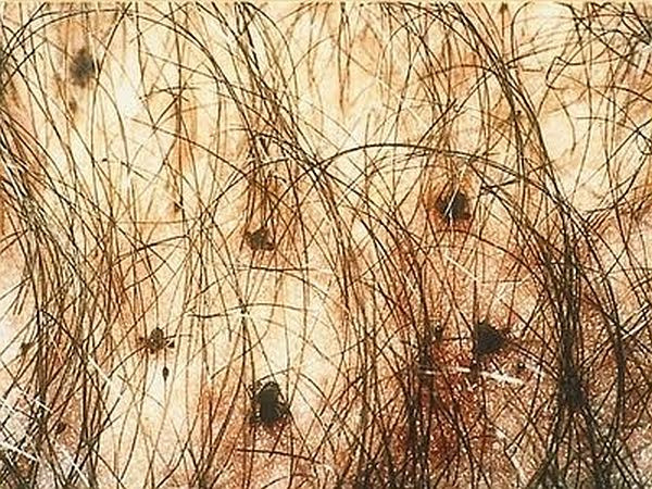 Ở một số bệnh nhân xuất hiện những chấm có màu xám xanh hoặc xám đen ở những vùng bị rận hút máu, các chấm này có thể kéo dài trong nhiều ngày.