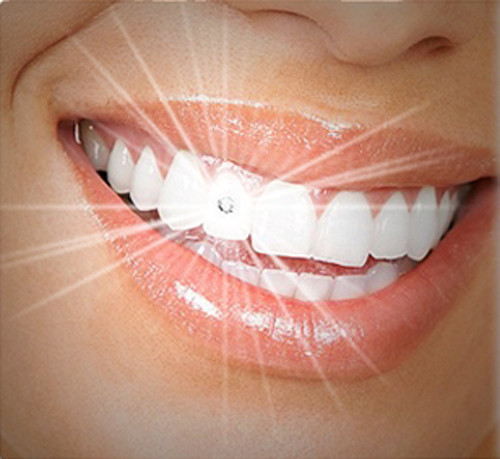 Không chỉ trồng thêm răng khểnh mà mốt đính đá vào răng đang được không ít người coi đó là tiêu chí cho sự sành điệu. Với quan điểm gắn kim cương vào răng để “nụ cười thêm duyên dáng và đời thêm tươi sáng”, nhiều bạn trẻ đã sẵn sàng bỏ ra cả chục triệu đồng chỉ để có nụ cười nổi bật giữa đám đông.