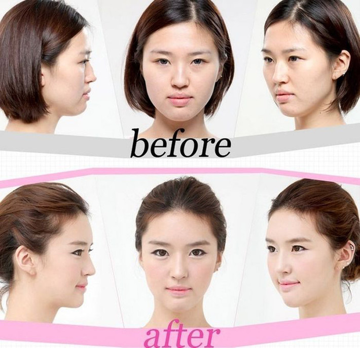 Thậm chí, nhiều bậc cha mẹ tại Hàn Quốc còn dành tặng một ca phẫu thuật thẩm mỹ cho con cái để chào mừng các con trưởng thành.