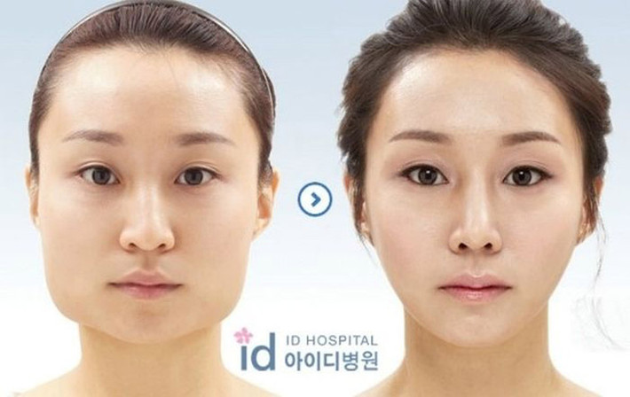 Rất nhiều bức ảnh trước và sau phẫu thuật đã từng được công bố khiến nhiều người không khỏi ngạc nhiên trước sức mạnh của công nghệ dao kéo.