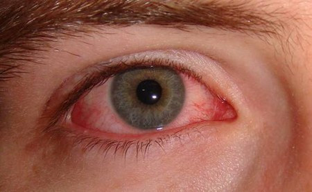 Thành phần chống viêm như corticoid còn tạo điều kiện cho vi khuẩn phát triển. nếu đau mắt đỏ nguyên nhân do vi khuẩn cần được điều trị bằng kháng sinh. Để phát hiện nguyên nhân bệnh cũng như điều trị bằng kháng sinh một cách an toàn cần sự tư vấn của bác sĩ. Tự ý điều trị ở nhà mà không khỏi gây nguy cơ kháng thuốc cao, điều trị sau đó khó khăn, tốn thời gian và làm bệnh nặng hơn.