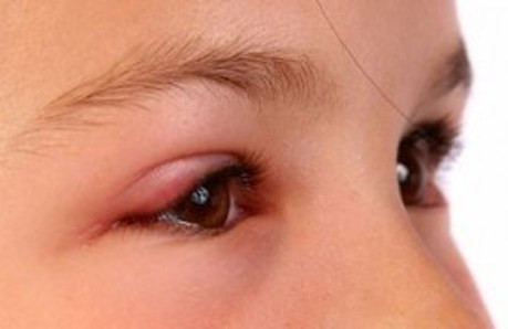 Đau mắt đỏ không nguy hiểm? Bệnh đau mắt đỏ là một bệnh cấp tính, khởi phát ồ ạt nhưng lành tính, nếu điều trị đúng cách sẽ khỏi hoàn toàn và không để lại di chứng. Tuy nhiên những chủ quan trong phòng chống và chữa trị có thể dẫn đến những biến chứng nặng hơn như gây viêm loét hoặc thủng giác mạc.