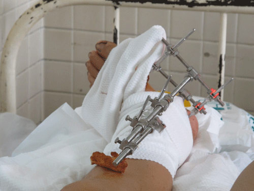 Việc nối lại phần cơ thể đứt lìa có những chỉ định nhất định và tỉ lệ thành công tùy thuộc vào tuổi, tình trạng của tổn thương, thời gian từ khi bị tai nạn đến khi phẫu thuật… Nhưng nếu phần đứt rời được bảo quản đúng cách thường có những kết thúc rất có hậu.