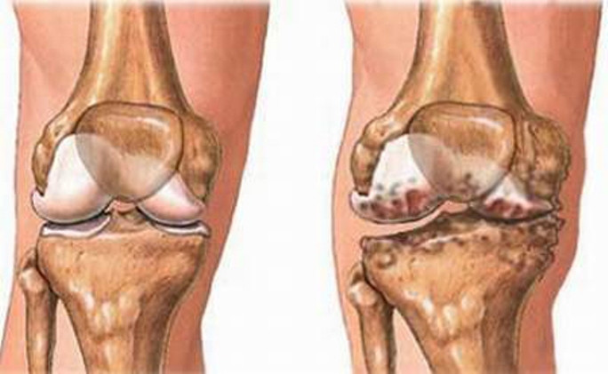 Hơn 90% các trường hợp tháo khớp được thực hiện tại Mỹ là do biến chứng của bệnh tiểu đường, 60-80% phải tháo khớp cả hai chân hoặc cả bàn chân.
