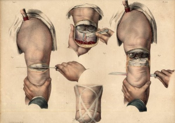 Để tháo khớp, các bác sĩ sẽ rạch vòng quanh phần muốn cắt bỏ, sau đó cắt ngọt vào phần gân nối giữa các khớp, phải người có chuyên môn cao mới thực hiện được thủ thuật này. Nếu trong trường hợp cứu sống bệnh nhân, các bác sĩ sẽ phải cầm máu, khâu lại vị trí tháo khớp.