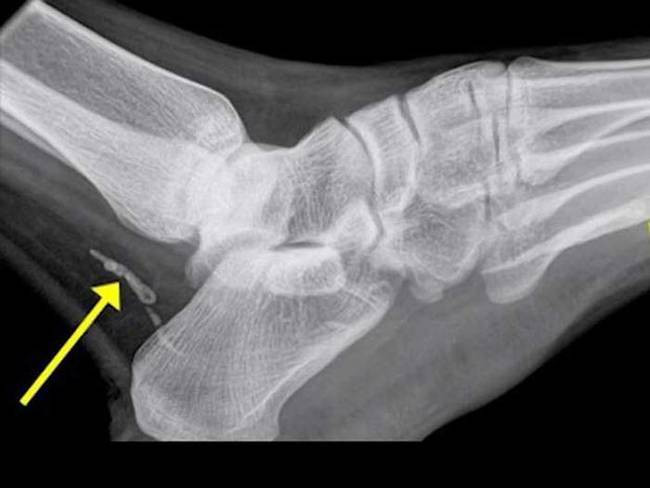 Người đàn ông này chụp X-quang mới biết chân mình bị nhiễm giun. Nếu không nhanh chóng loại bỏ, con giun này có thể phát triển tới gần 1m trong cơ thể người.