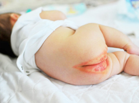 Bé dễ bị hăm tã vào mùa hè. Mùa hè nóng nực, mẹ chăm đóng tã cho bé thì bé sẽ rất dễ bị hăm kẽ hoặc viêm da do tã lót khiến vùng da nhạy cảm không được thông thoáng.