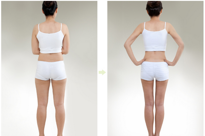 Cách 2: Cắt toàn bộ cơ sinh đôi. Bắp chân sẽ nhỏ đi nhiều sau khi cắt toàn bộ cơ sinh đôi. Tuy nhiên, nên nhớ rằng hình dáng của bắp chân quan trọng hơn là kích thước của bắp chân. So với bắp chân thon, bắp chân của phụ nữ có “bắp chân củ cải” thì cơ dầy hơn, như vậy thay vì làm lấy bỏ cơ bắp chân thì nên làm thế nào cho cơ mỏng đi. Hình dáng của bắp chân sau khi cắt toàn bộ cơ sinh đôi sẽ không tự nhiên.