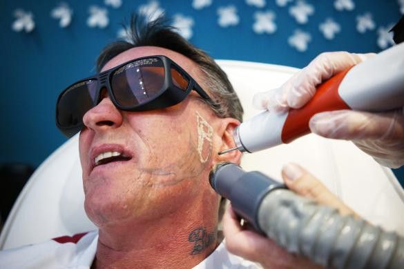James Ward đang thực hiện tiến trình xóa bỏ hình xăm bằng tia laser trên mặt mình tại trung tâm thành phố Denver, Mỹ.