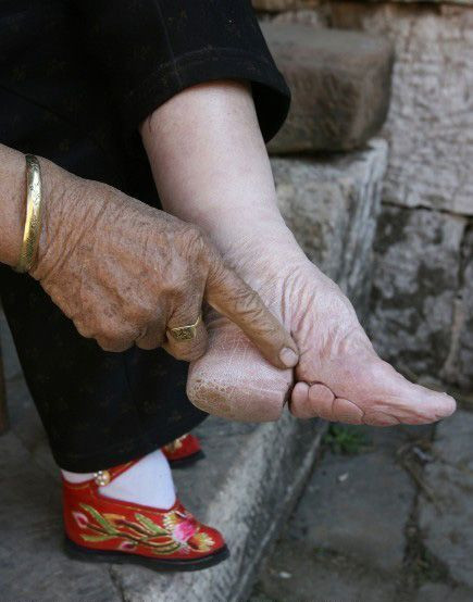 Và hậu quả nguy hiểm của phương pháp làm này khiến bàn chân của họ bị biến dạng hoàn toàn, gây trở ngại rất lớn trong việc đi lại, sinh hoạt hàng ngày kèm theo những cơn đau nhức nhối thế nhưng những người phụ nữ Trung Quốc vẫn “cắn răng chịu đựng” để làm đẹp.