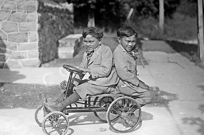 Cặp song sinh Lucio và Simplicio Godina sinh ra tại Samar ở Philippines, sinh năm 1908. Cặp đôi này bị dính liền phần sụn dưới lưng và mông, tuy nhiên Lucio bị viêm phổi năm 1936 và sau đó qua đời, một cuộc phẫu thuật khẩn cấp đã được thực hiện để tách rời cặp đôi, tuy nhiên, 12 ngày sau đó Simplicio Godina đã qua đời 12 ngày sau đó do viêm màng não.