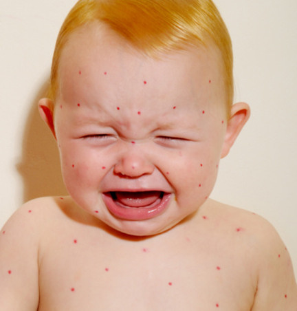 Mắt đỏ và nhạy cảm với ánh sáng mặt trời