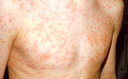 Viêm phổi: Đây là một trong những biến chứng thường gặp nhất. Viêm phổi có thể do chính virut sởi gây tổn thương mô kẽ và cũng có thể do bội nhiễm vi trùng khác. Tác nhân thường là phế cầu liên cầu tiêu huyết, tụ cầu vàng.