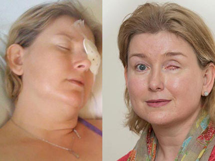 Mù mắt vì kính áp tròng. Jacqui Stone, 42 tuổi, giáo viên dạy toán, người Anh đeo kính áp tròng 20 năm. Sau khi bà mua một chiếc kính áp tròng mới, nhãn hiệu Focus Dailies All-Day, hãng kính nổi tiếng thứ nhì ở Anh thì bị nhiễm một loại nấm hiếm gặp.