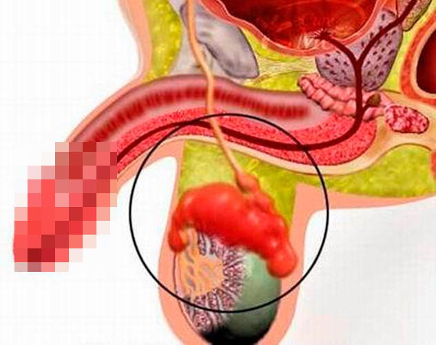 U thường có hình trứng, kích thước vài cm với trọng lượng có thể lên tới hàng trăm gam. U có vỏ xơ nhẵn bao bọc, ở dạng nang chứa dịch nâu hoặc vàng... Biểu hiện của bệnh là tinh hoàn to dần, chắc, nhưng không sưng nóng đỏ, có hạch bẹn to hoặc u ổ bụng khi đã có di căn. Mặc dù triệu chứng của bệnh dễ dàng nhận thấy nhưng cũng có những trường hợp chẩn đoán lâm sàng là u, phải mổ cắt bỏ tinh hoàn, khi xét nghiệm mô bệnh học thì lại là lao hoặc viêm tinh hoàn hoại tử.