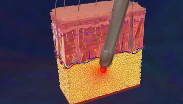 Người ta sử dụng sức nóng của tia laser được đưa vào dưới da để làm tan mỡ trước khi loại bỏ chúng ra khỏi cơ thể. Điểm mạnh của phương pháp này đó chính là việc giúp da bạn trở nên săn chắc, độ đàn hồi cao và ít gây thâm tím cho da. Ngược lại, chúng cũng mang đến không ít phiền toái vì khiến da bạn dễ bắt nắng hơn, để lại sẹo lớn và đau đớn kéo dài.