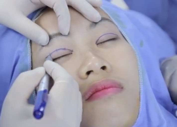 Nhấn mí không phẫu thuật. Ngày nay, dịch vụ bấm mí mắt không phẫu thuật đang được rất nhiều bạn trẻ ưa chuộng và lựa chọn. Đây là công nghệ có nguồn gốc xuất xứ từ Hàn Quốc với nhiều ưu điểm vượt trội đã khắc phục hoàn toàn nhược điểm của công nghệ truyền thống trước đây.