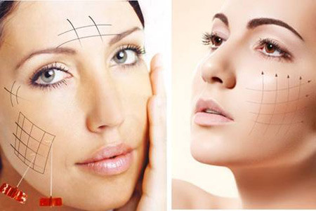 Nâng cơ mặt không phẫu thuật. Căng da mặt bằng chỉ tạo hình chữ V: là phương pháp hữu hiệu để tạo hình gương mặt, nâng cơ mặt không phẫu thuật, đặc biệt đối với da chảy xệ, giúp kích thích cơ chế sản sinh collagen. Phương pháp này có ưu điểm nâng cơ mặt không cần phẫu thuật.
