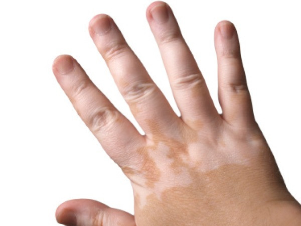 Bệnh bạch biến. Bạch biến là một bệnh mất sắc tố ở da, lông, tóc. Tỉ lệ mắc bệnh khoảng 1-2% dân số, người da màu mắc bệnh nhiều hơn da trắng. Bệnh có ở mọi lứa tuổi nhưng thường ở người trẻ.