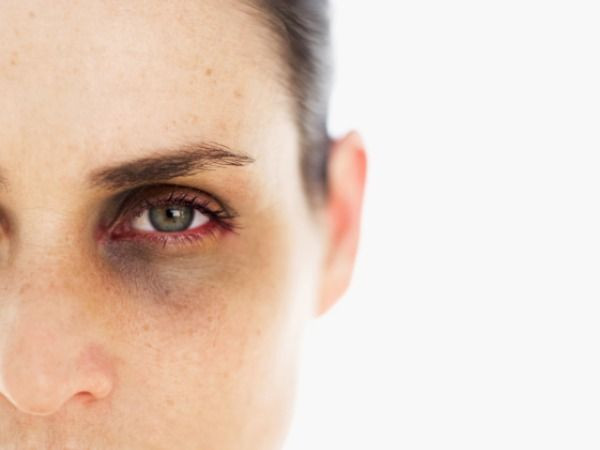 Quầng thâm dưới mắt. Căn bệnh này có thể là do di truyền, nhưng nó cũng có thể bị gây ra do quá trình lão hóa, thiếu ngủ, thiếu chất dinh dưỡng và ảnh hưởng nội tiết...