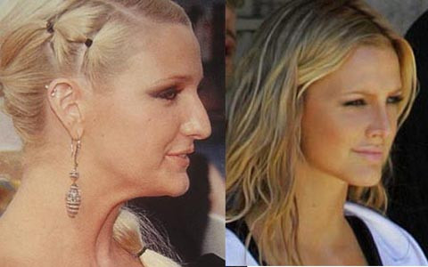 Ashlee Simpson. Nằm trong số những điển hình về phẫu thuật thẩm mỹ thành công, Ashlee Simpson chỉnh sửa chiếc mũi to của mình cho thon nhỏ hơn, thẳng hơn vào năm 2006. Điều này càng tôn thêm vẻ đẹp sẵn có của cô.