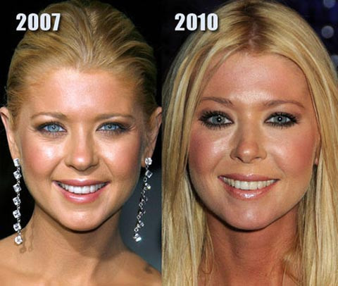 Tara Reid. Có thể nói diễn viên Tara Reid nằm trong danh sách những người phẫu thuật thẩm mỹ thành công nhất.