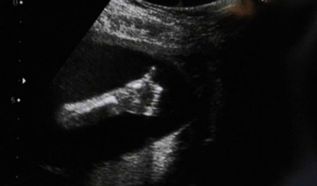 Thai nhi giơ biểu tượng "tuyệt vời". Sau lần siêu âm đầu tiên, cặp đôi Donna và Simon Biscoe đã rất chờ đợi những hình ảnh tiếp theo của bé. Và họ cũng được báo đáp phần nào với bức ảnh em bé giơ một ngón tay cái như ra hiệu rằng: "Tất cả vẫn ổn!".