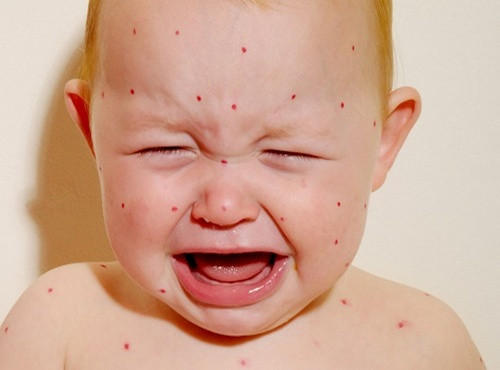 Nên ăn các loại thức ăn mềm, dễ tiêu hóa, và chứa đầy đủ chất dinh dưỡng.