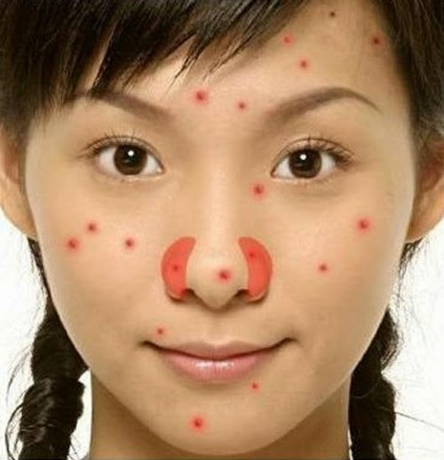 Mụn lan rộng hơn. Việc nặn mụn là rất cực kì nguy hiểm, lí do là các lỗ nhỏ này có thể chui vào máu và góp phần ảnh hưởng vào việc lan rộng mụn trên toàn bộ khuôn mặt. Các nhà chuyên môn đã thực hiện hàng loạt các cuộc nghiên cứu để đưa ra một trong những lí do chính bạn không nên cậy mụn đó là vi khuẩn có thể lan rộng ra các bộ phận và tăng số lượng mụn.