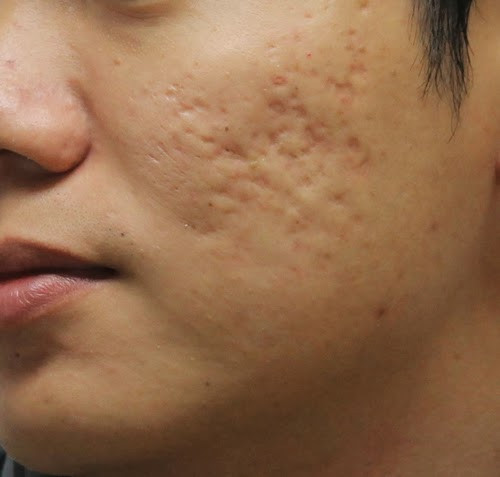 Để lại sẹo. Chắc chắn bạn đã từng thấy những người có sẹo mụn trên da. Đây chắc chắn là một dấu hiệu của chế độ chăm sóc mụn không hợp lí. Sẹo là một trong những dấu hiệu dễ nhìn thấy nhất khi bạn sử dụng sai các sản phẩm hoặc dụng cụ làm đẹp. Do đó, thay vào việc tổng khứ cả đống bệnh về da vào mặt, bạn nên ngừng ngay việc cậy mụn.