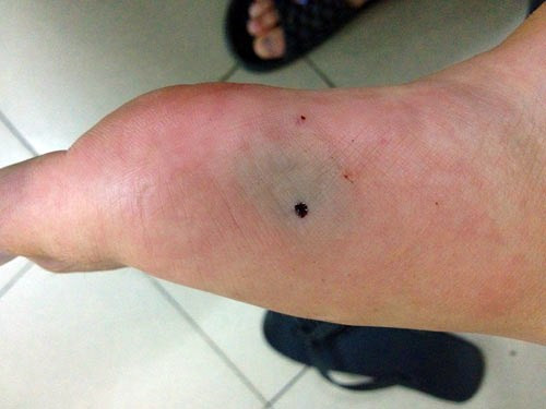 Nạn nhân sẽ nhanh chóng bị ngộ độc và ngày càng nặng nếu vết thương sâu, nhiều nọc độc, loại rắn độc hơn, cơ thể nhỏ bé, sức khoẻ của nạn nhân đang không tốt và đặc biệt nạn nhân vận động nhiều sau khi bị cắn. Các triệu chứng thường xuất hiện sớm, nhanh chóng và gây nguy hiểm cho nạn nhân, dễ tử vong. Biểu hiện về thần kinh thường là liệt, trước tiên thường là mắt không thể mở to, đau họng, khó nuốt, nói khó, sau đó là khó thở và loạn nhịp tim.