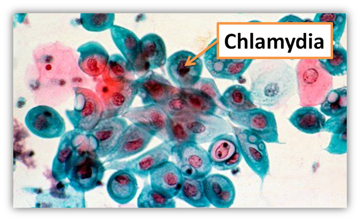 Bệnh nhiễm trùng chlamydia là bệnh do một loại vi sinh vật trung gian giữa vi khuẩn và vi rút gây ra. Biểu hiện của bệnh chlamydia thường xuất hiện ở mắt, gọi là triệu chứng “mắt hồng” hoặc viêm kết mạc và có khả năng gây mù. Kiểm tra bằng cách kiểm tra nước tiểu hoặc thử nghiệm phòng thí nghiệm của mẫu tăm bông.