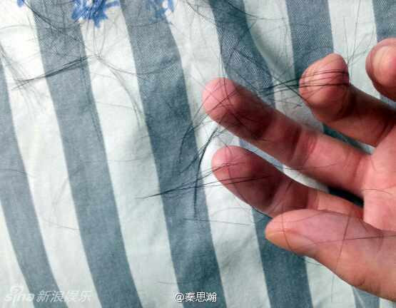 Những đợt hóa trị đã khiến chàng cảnh sát rụng dần tóc.
