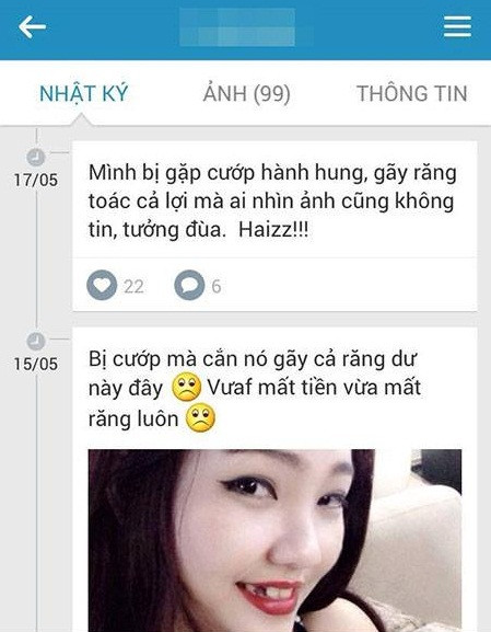 A.A vui vẻ khoe chiến tích cắn cướp đến gãy răng của mình trên trang Facebook cá nhân và không quên kèm theo lời than vãn rằng câu chuyện của mình có thật mà mọi người cứ tưởng đùa.
